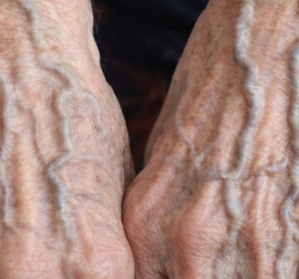 Bulging Veins …When They’re Harmless and When They Could Signal a Problem Bulging Veins …When They’re Harmless and When They Could Signal a Problem
