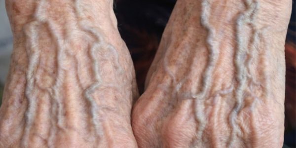 Bulging Veins …When They’re Harmless and When They Could Signal a Problem