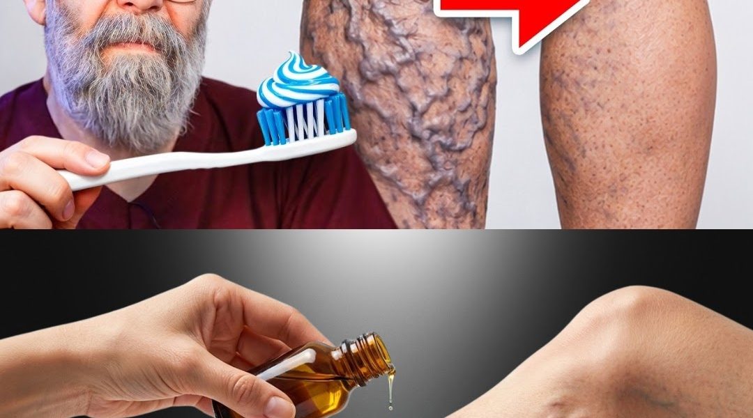 5 Natural Ways to Get Rid of Varicose Veins Fast (Backed by Science) 5 Natural Ways to Get Rid of Varicose Veins Fast (Backed by Science)