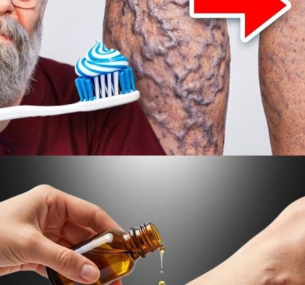 5 Natural Ways to Get Rid of Varicose Veins Fast (Backed by Science)