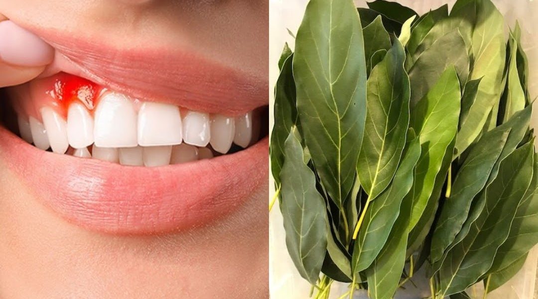 Natural Relief for Swollen and Bleeding Gums