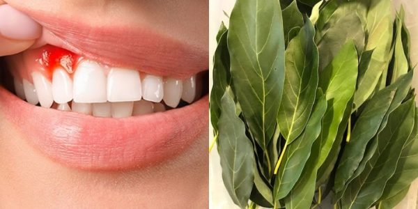 Natural Relief for Swollen and Bleeding Gums