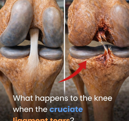 Torn ACL Explained: What Happens to the Knee When the Anterior Cruciate Ligament Tears – Key Insights
