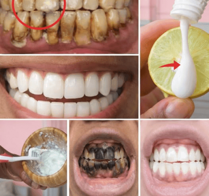 A Guide to Naturally Whitening Yellow Teeth at Home with Banana, Ginger, and Lemon Ingredients
