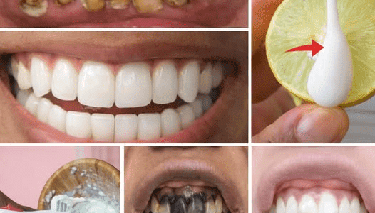 A Guide to Naturally Whitening Yellow Teeth at Home with Banana, Ginger, and Lemon Ingredients A Guide to Naturally Whitening Yellow Teeth at Home with Banana, Ginger, and Lemon Ingredients