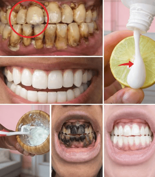 A Guide to Naturally Whitening Yellow Teeth at Home with Banana, Ginger, and Lemon Ingredients A Guide to Naturally Whitening Yellow Teeth at Home with Banana, Ginger, and Lemon Ingredients