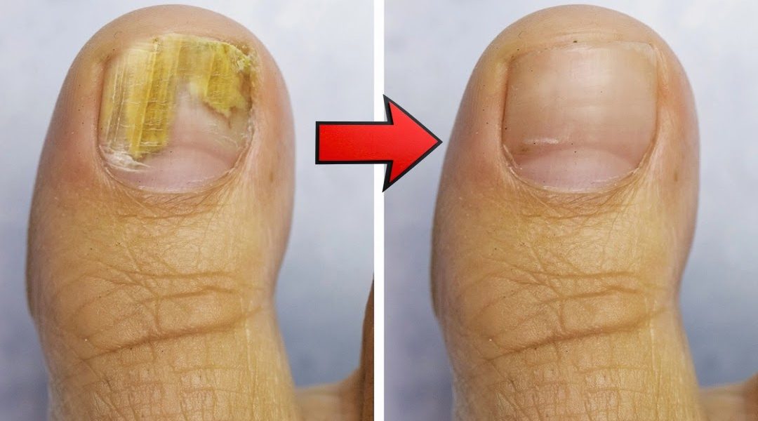 Home Remedy for Nail Fungus with Vinegar and Baking Soda Home Remedy for Nail Fungus with Vinegar and Baking Soda