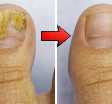 Home Remedy for Nail Fungus with Vinegar and Baking Soda Home Remedy for Nail Fungus with Vinegar and Baking Soda