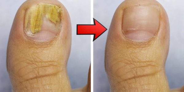 Home Remedy for Nail Fungus with Vinegar and Baking Soda Home Remedy for Nail Fungus with Vinegar and Baking Soda