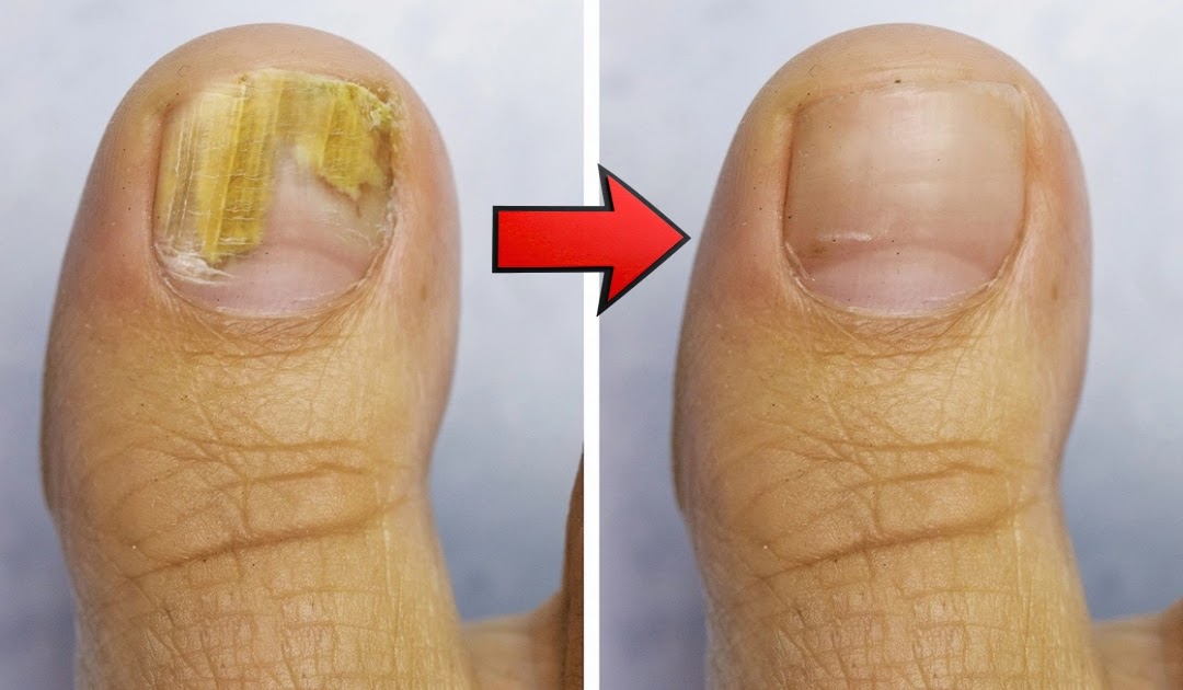 Home Remedy for Nail Fungus with Vinegar and Baking Soda Home Remedy for Nail Fungus with Vinegar and Baking Soda