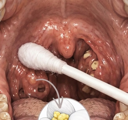 A Hidden Cause of Persistent Bad Breath A Hidden Cause of Persistent Bad Breath